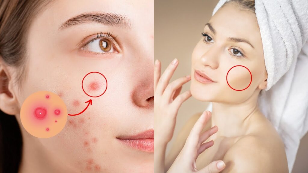 Acne treatment for kids and adults for clear healthy skin