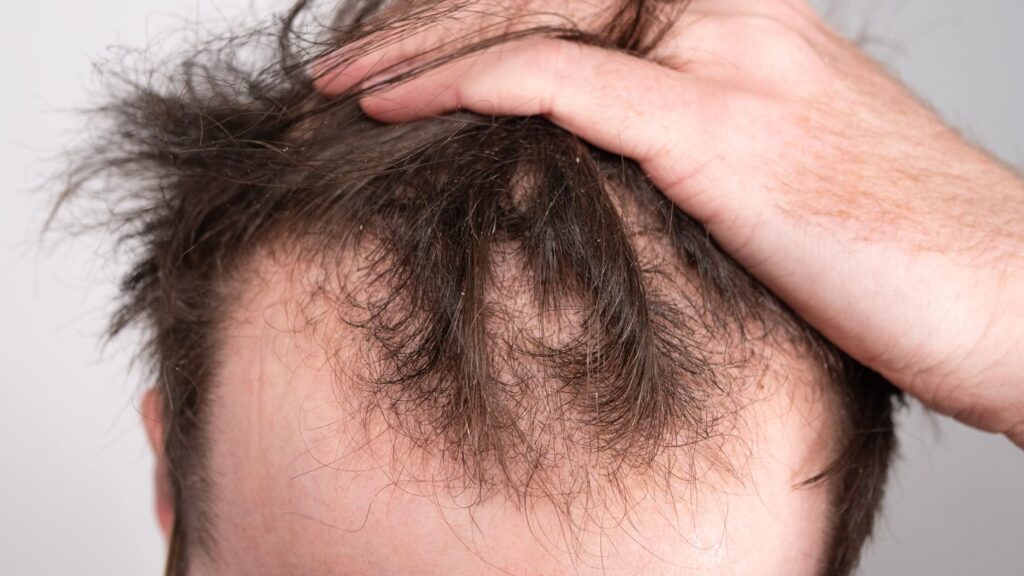 Hair Loss Treatment - Adore Skin Clinic