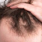 Hair Loss Treatment - Adore Skin Clinic