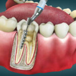 4D Root Canal Image
