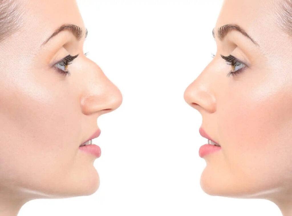 Rhinoplasty in Dubai