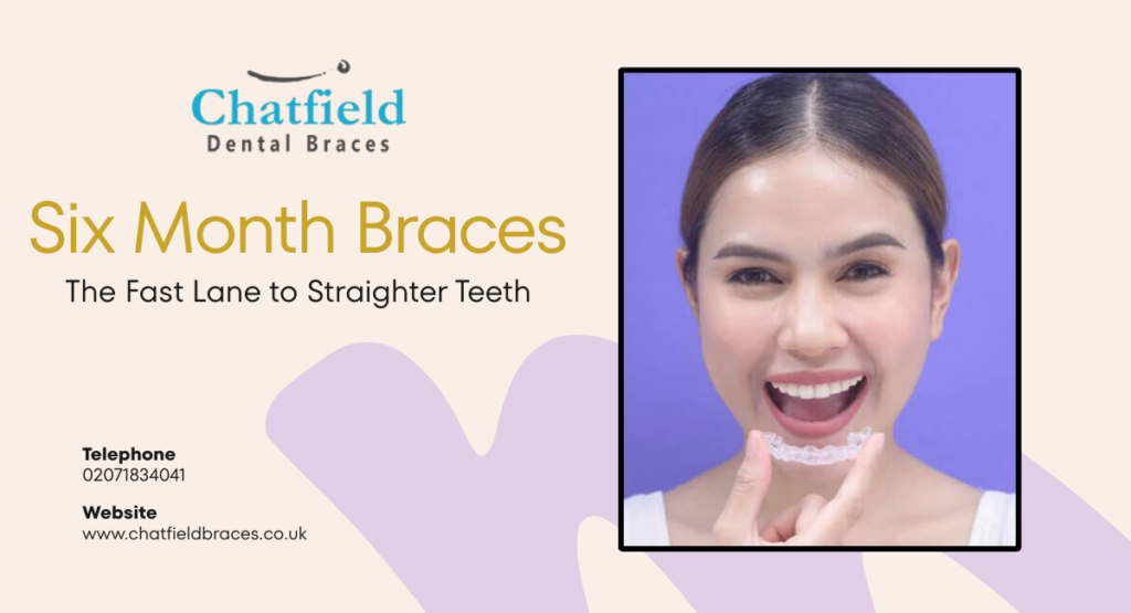 Six Month Braces: The Fast Lane to Straighter Teeth
