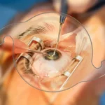 Exploring Options for the Best Cataract Surgeon in Dubai
