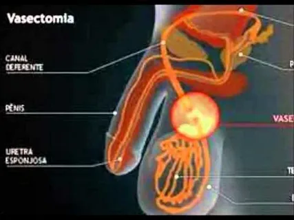 No Scalpel Vasectomy and Accelerated Wound Closure