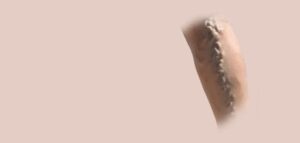 varicose veins specialist in ahmedabad