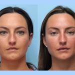 Best Plastic Surgeon in Dubai Offering Advanced Thread Lift Solutions for Youthful Skin