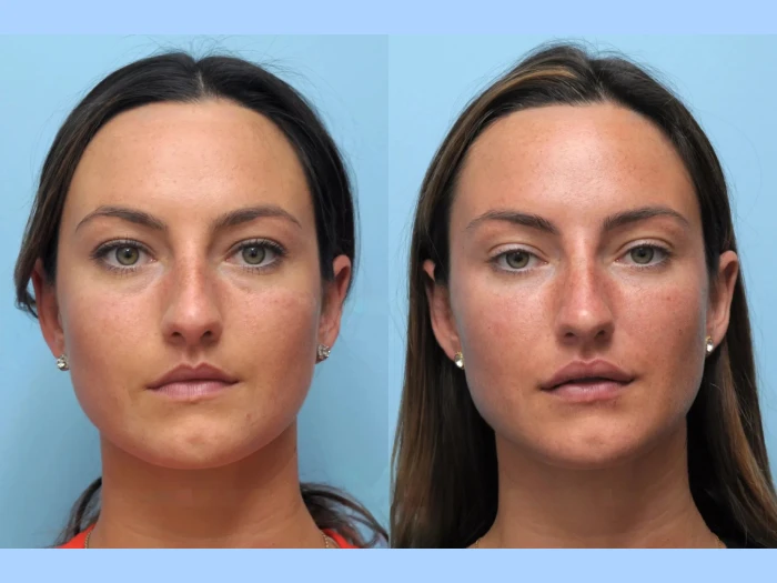 Best Plastic Surgeon in Dubai Offering Advanced Thread Lift Solutions for Youthful Skin