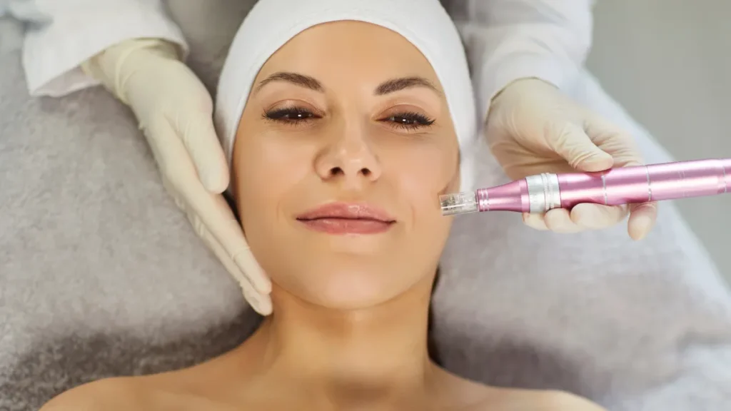 Everything You Should Know About RF Microneedling Procedure
