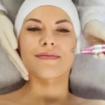 Everything You Should Know About RF Microneedling Procedure
