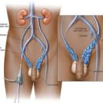 varicocele embolisation